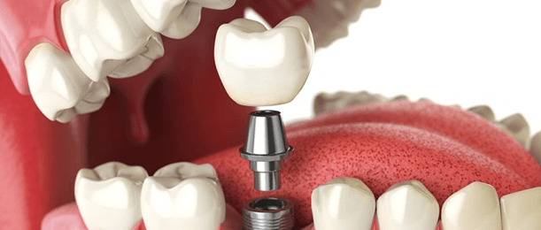 a digital illustration of a dental implant and abutment