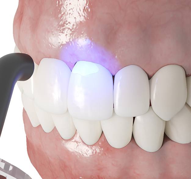 Illustration of cosmetic dental bonding in Jacksonville