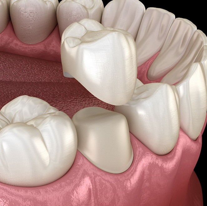 Illustration of a dental crown being placed on a tooth