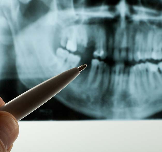Emergency dentist in Jacksonville pointing at an X-ray with pen