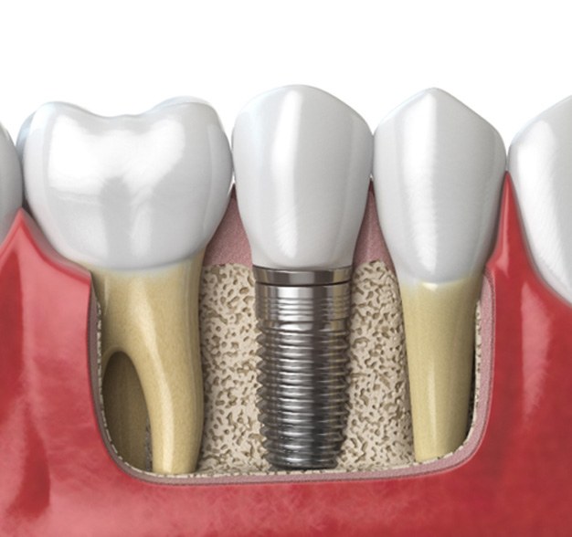 Digital illustration of dental implant