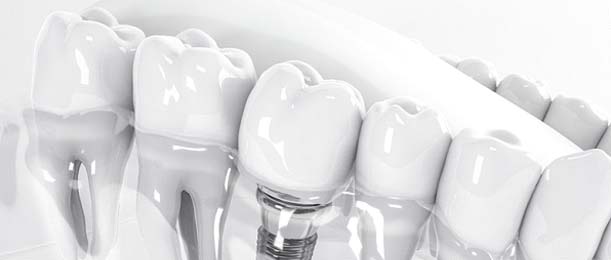 Dental implant in Jacksonville