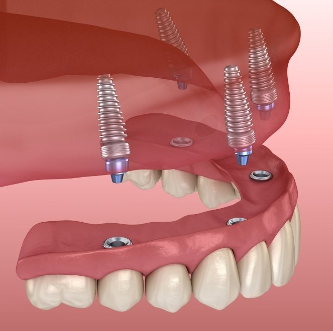 Animated implant supported denture placement