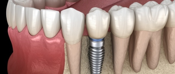 Animated implant supported dental crown