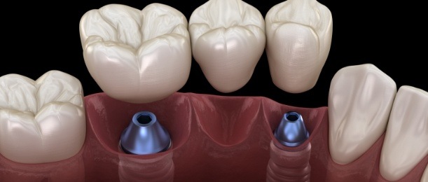 Animated implant supported fixed bridge