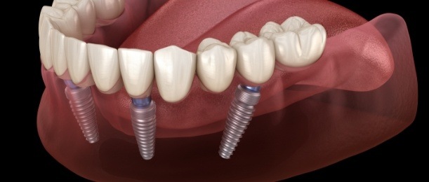 Aniamted implant supported denture