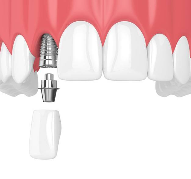 Diagram highlighting components of a dental implant in Jacksonville