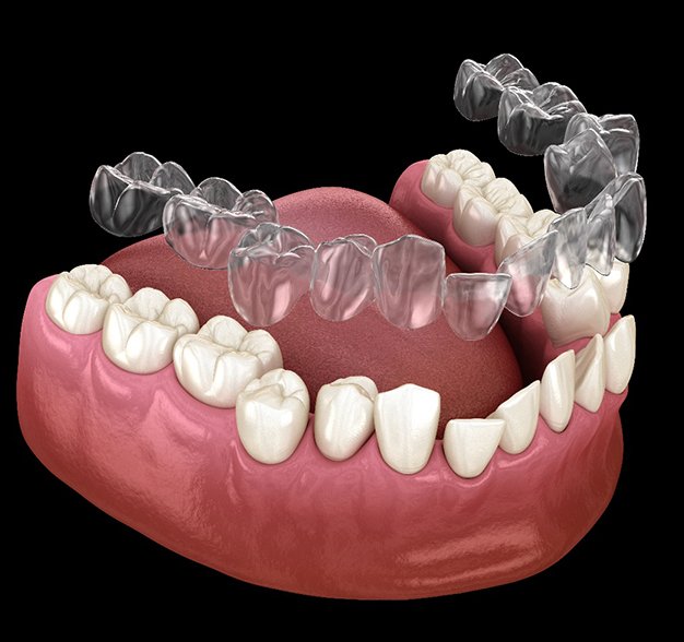 A digital image of an Invisalign aligner going on over the lower arch of teeth