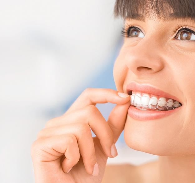 A young female with bangs inserting an Invisalign clear aligner into her mouth