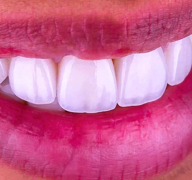 An up-close look at a person’s smile that has been straightened using Invisalign