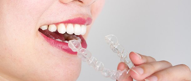 Woman removing Invisalign aligner from mouth