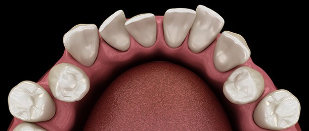 Bird’s eye view looking down at illustration of crooked lower arch with black background