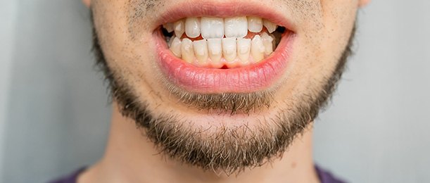 Nose-to-neck closeup of man with underbite and Invisalign attachments on teeth