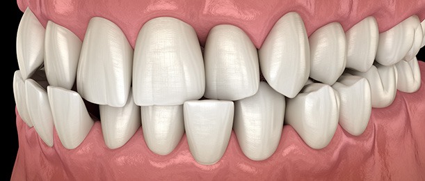 3D rendering of a crossbite with black background