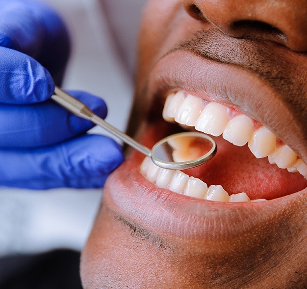 Dentist checking a man's tooth-colored fillings