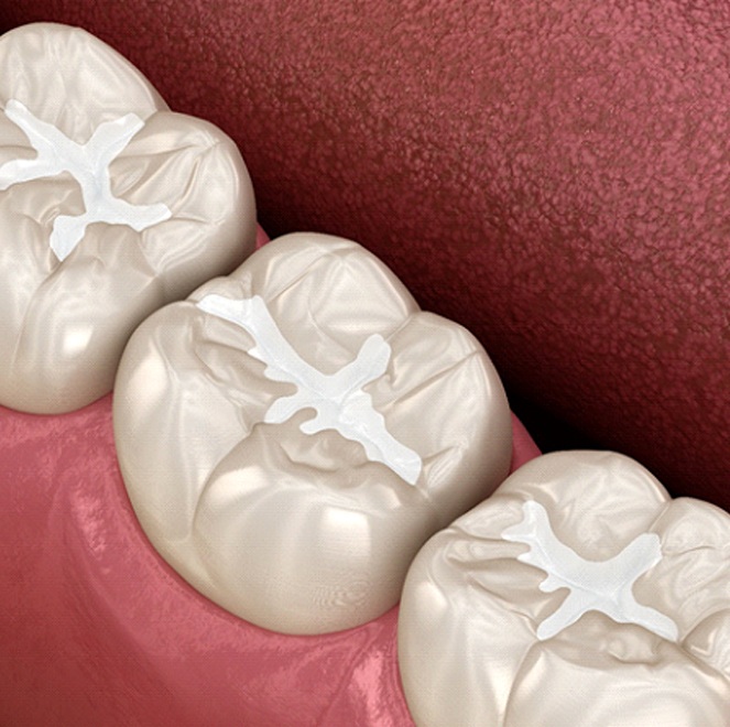 3D illustration of tooth-colored fillings