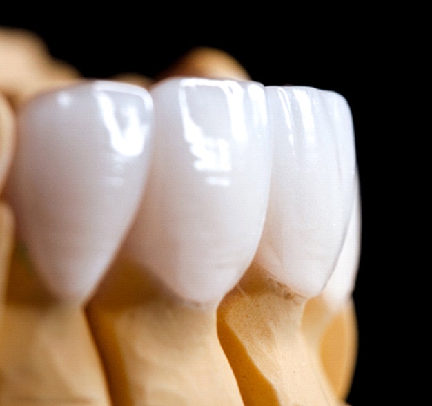 Closeup of model of veneers