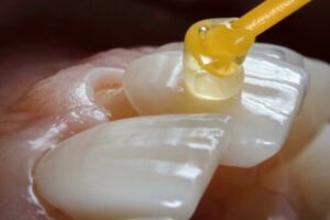 Veneer being applied to tooth.